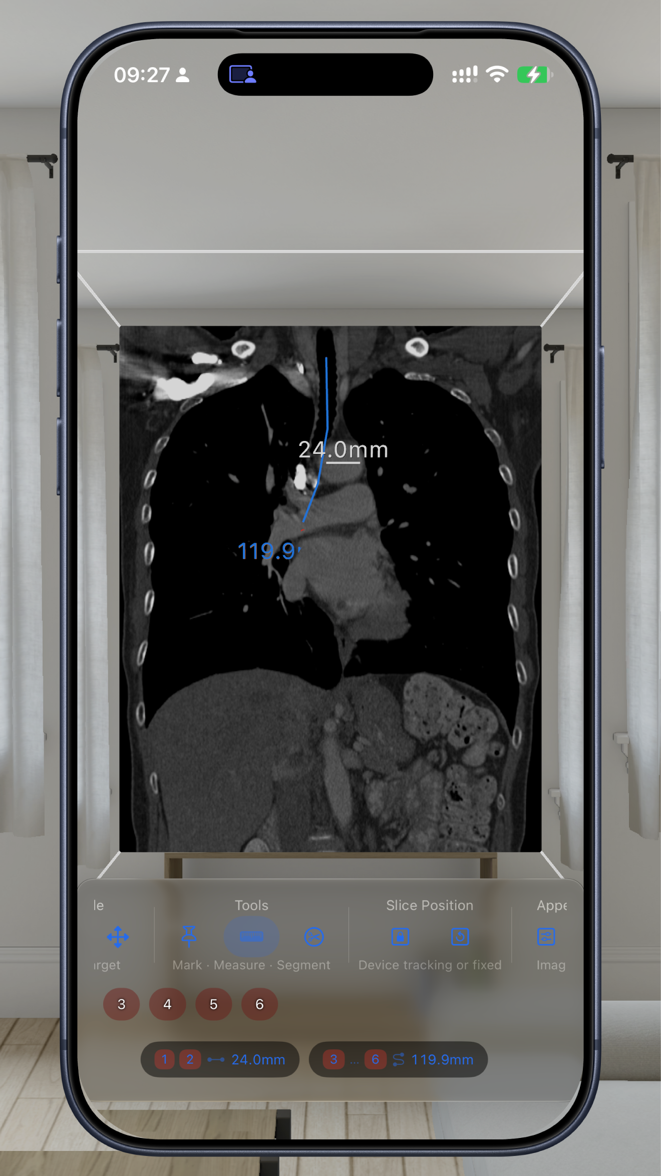 Distance and path measurements on a CT volume in VoxelVision 2.0 on iPhone