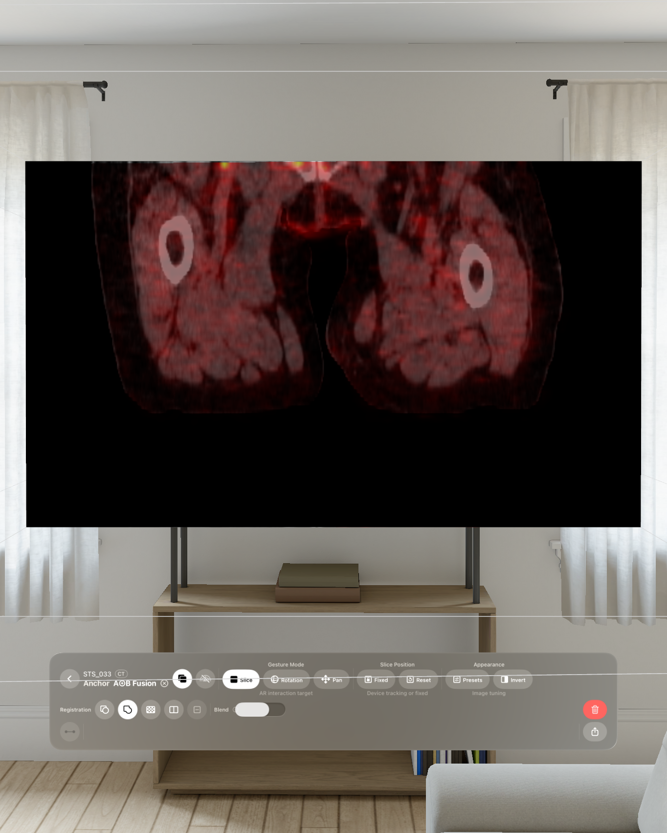 Registered CT and PET fusion in VoxelVision 2.0 on Apple Vision Pro