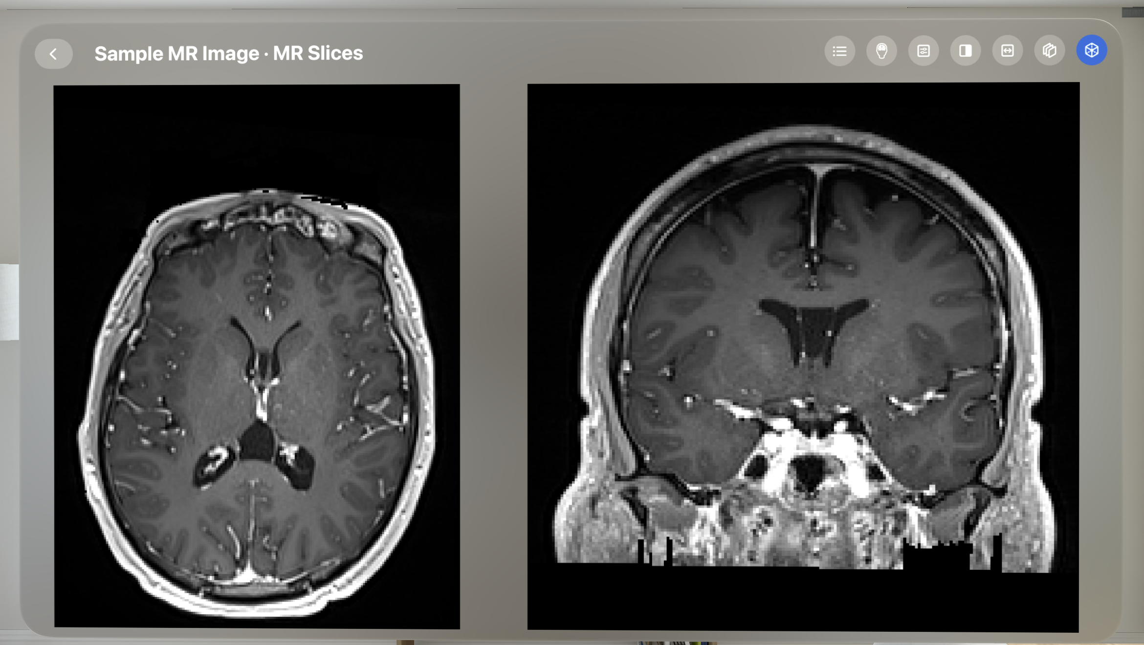 MR brain axial and coronal views in VoxelVision 2.0 on Apple Vision Pro