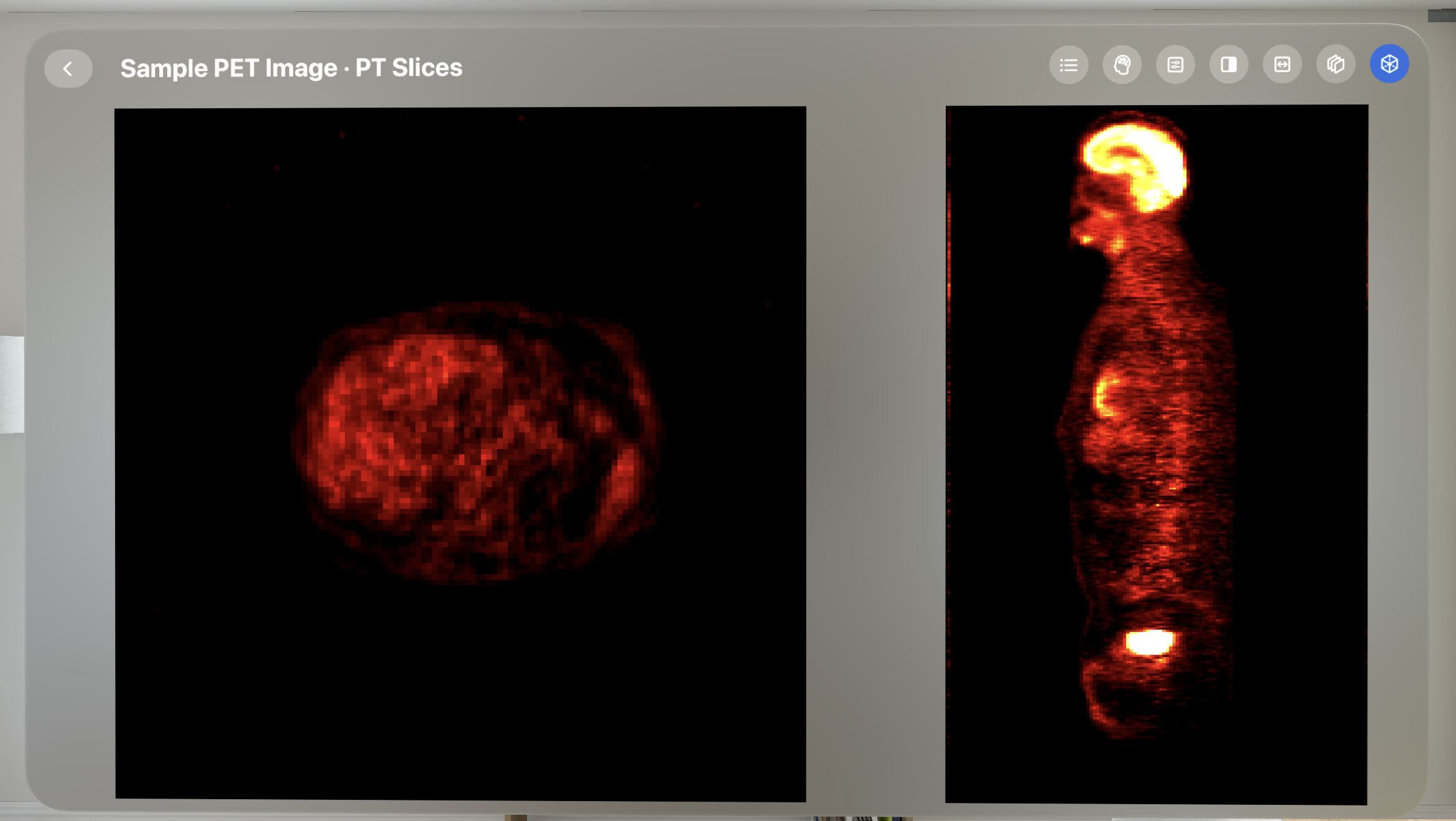 PET axial and whole-body views in VoxelVision 2.0 on Apple Vision Pro