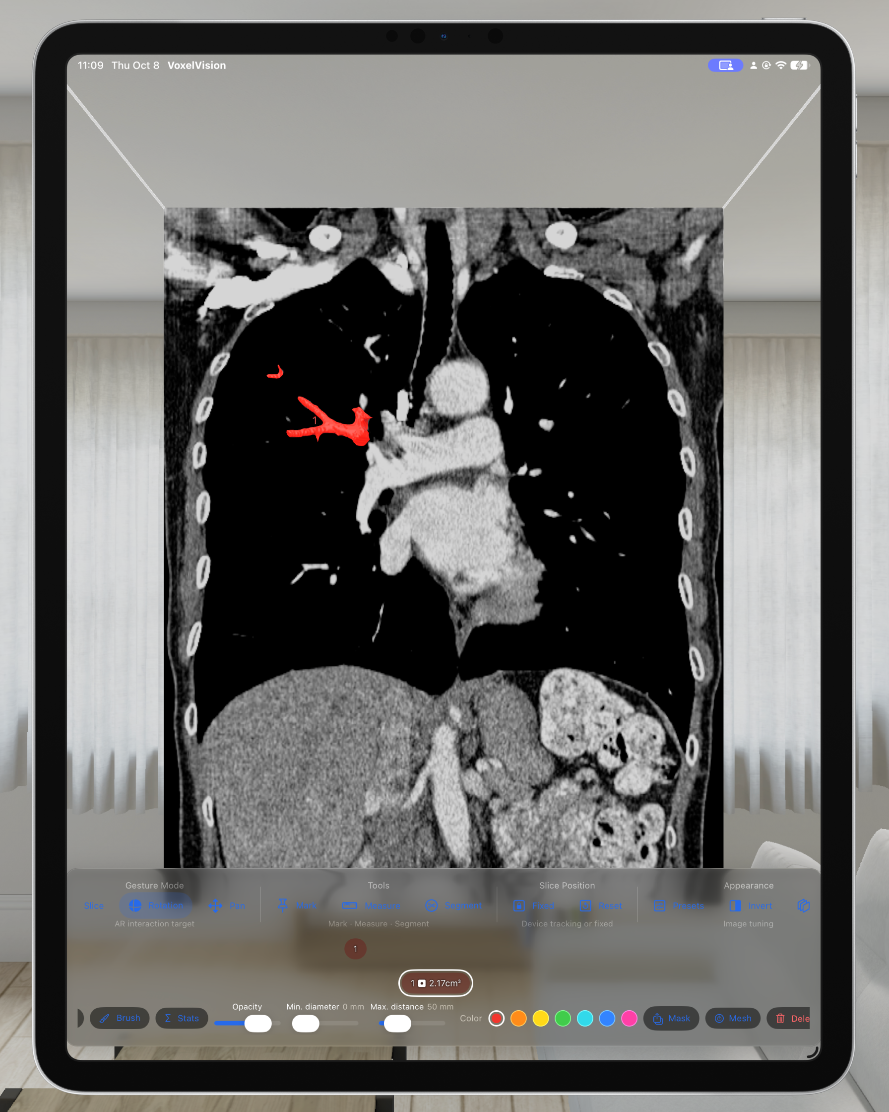 Pulmonary vein segmentation on a CT volume in VoxelVision 2.0 on iPad